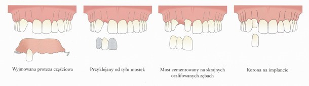 Przykłady uzupełnienia protetyczego