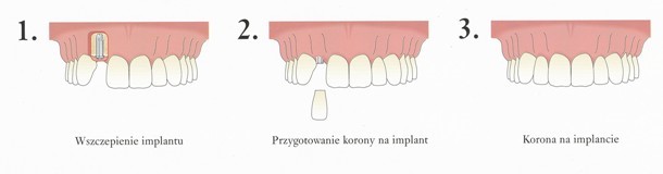 Etapy leczenia protetycznego (wczepienie implantu, przygotowanie korony na implant, korona na implancie)