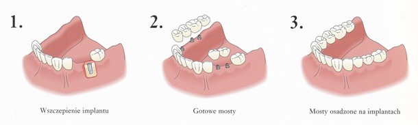 Etapy leczenie (wczepienie implantu, gotowe mosty, mosty osadzone na implantach)