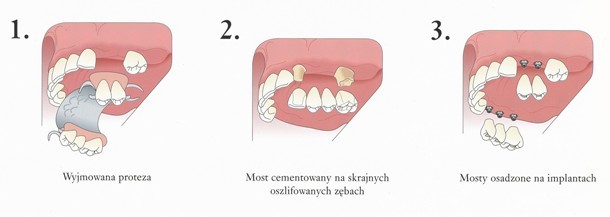 Możliwości uzupełnień protetycznych (wyjmowana proteza, most cementowany na skrajach oszlifowanych zębach, mosty osadzone na implantach)