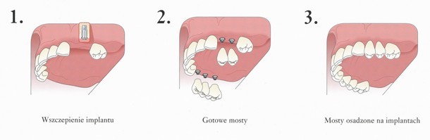 Etapy leczenia (wszczepienie implantu, gotowe mosty, most osadzone na implantach)