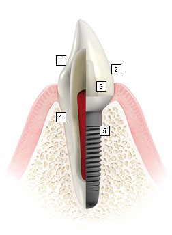 Przekrój implantu zęba 